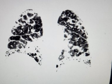 Pulmoner fibrozis. Göğüs tomografisi.