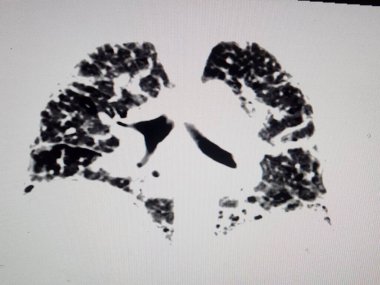 Pulmoner fibrozis. Göğüs tomografisi.