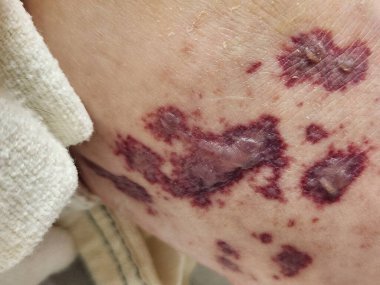 Deri ayrılması ve bullae ile lökositoklasik vaskülit