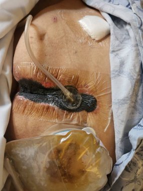 Süpürge yarası yerinde. Omurga cerrahi yarası.