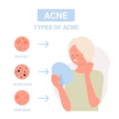 Farklı türde yüz sivilcesi. Kabarcık, siyah noktalar ve sivilce izleri düz vektör çizimi