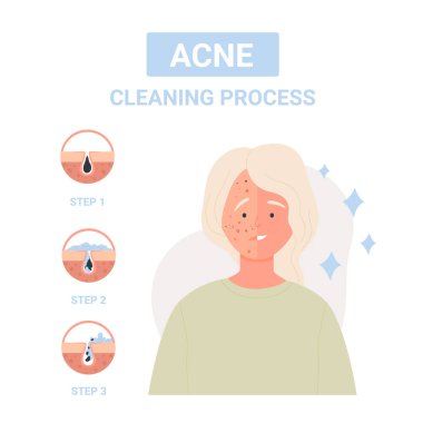 Deri sivilcelerine karşı temizleme işlemi için adımlar. Doğru akne tedavisi, gözenekler düz vektör illüstrasyonunu temizliyor