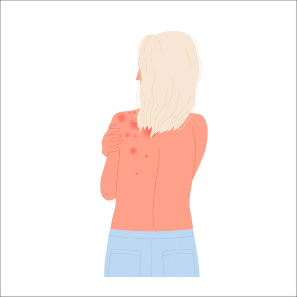 Вид Сзади Девушку Аллергией Тело Аллергическая Зудящая Реакция Иллюстрация Плоского — стоковый вектор