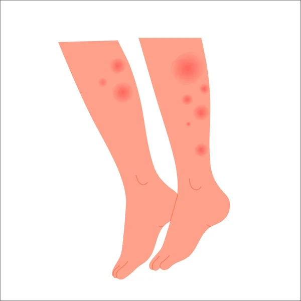 人的腿上布满红疹 脚部有过敏反应 皮肤刺激扁平载体说明 — 图库矢量图片