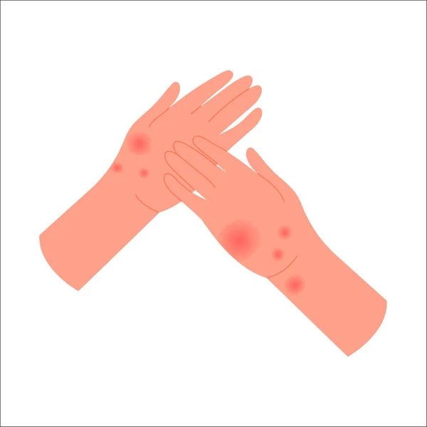 有过敏反应的人的手双手沾满红痒皮疹扁平的病媒图解 — 图库矢量图片