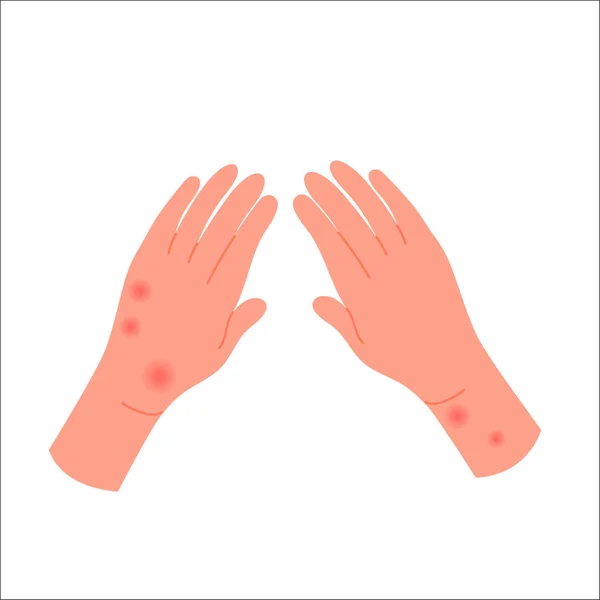 Tangan Manusia Ditutupi Dengan Ruam Merah Reaksi Gatal Alergi Dermatitis - Stok Vektor