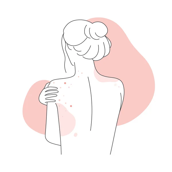 Зворотній Бік Тіла Жінки Алергічною Реакцією Шкіру Жіноче Тіло Покрите — стоковий вектор