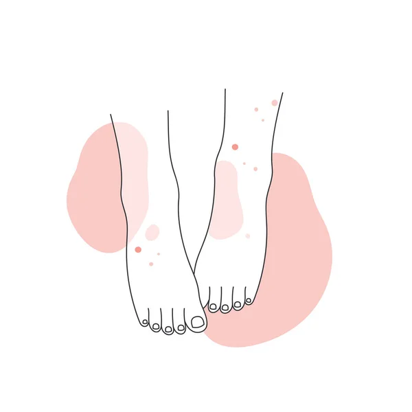 Ноги Людини Алергією Шкіру Ноги Покриті Червоною Висипкою Лінія Атопічного — стоковий вектор