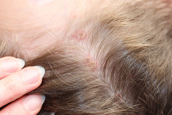 The child is sick with chickenpox. The boy has rashes all over his body, even on his head, which are incredibly itchy and painful.