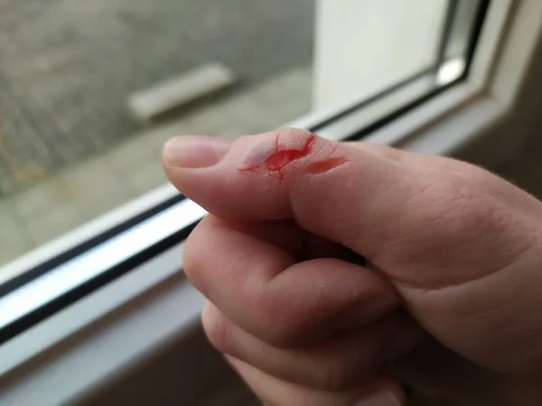 Female thumb with bleeding wound female hand shows cut injury with open wound and deep blade open flesh and bloody skin or bloody scar after clumsy kitchen injury need medical help or painful surgery