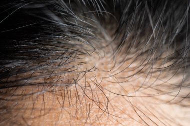 Saçlı genç kadın kafa derisi