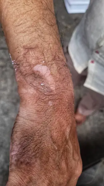 Kaynamış su yanığından su toplamış, derisi kırılmış bir adamın eli.