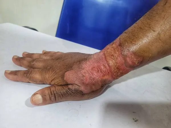 Kaynamış su yanığından su toplamış, derisi kırılmış bir adamın eli.