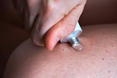 A man squeezes an anti-inflammatory gel treatment cream from a tube onto his leg. Treatment of arthrosis and arthritis, anti-inflammatory ointment for the treatment of joints, close-up clipart