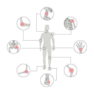Eklem iltihabının taşıyıcı illüstrasyonu