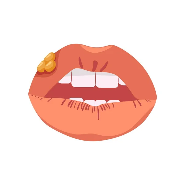 Χείλη Έρπη Λοιμώδης Νόσος Που Επηρεάζει Τους Βλεννογόνους Μορφή Φουσκάλες — Διανυσματικό Αρχείο