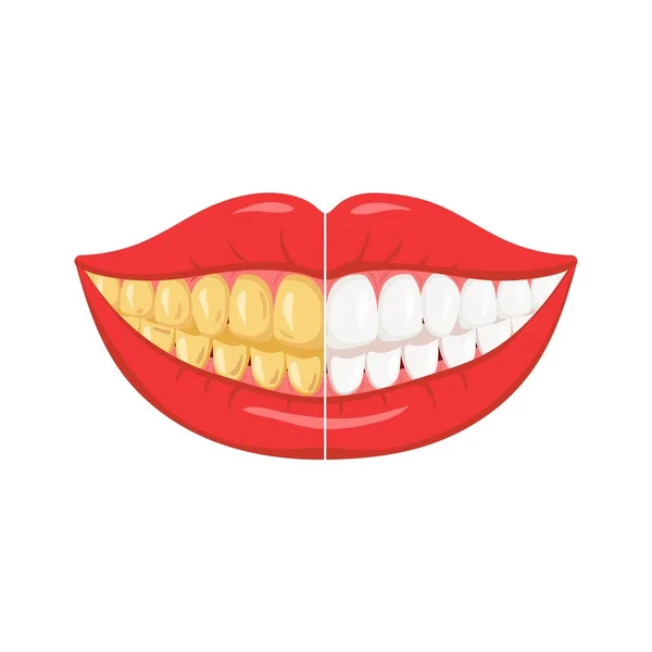 Зубы Табличкой Отбеливание Зубов После — стоковый вектор