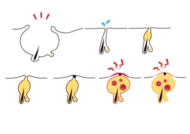 Sivilce ve gözenek kirliliği çizimleri