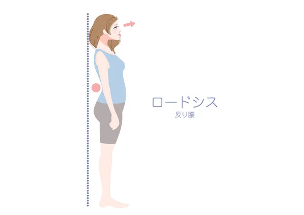 Ilustración Una Mujer Postura Lordosis Vista Desde Lado — Vector de stock