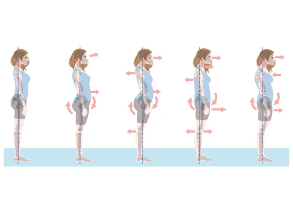 Clip Art Set Woman Bad Posture Seen Side — Stock Vector