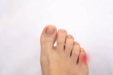 Inflammation on female foot with red spot. Concept of feet disease and pain
