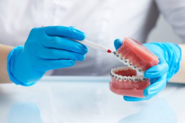 Orthodontist shows how the system of braces on teeth is arranged on an artificial jaws