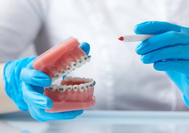 Orthodontist shows how the system of braces on teeth is arranged on an artificial jaws