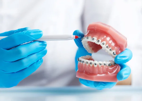 stock image Orthodontist shows how the system of braces on teeth is arranged on an artificial jaws