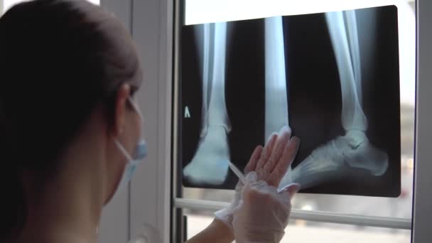 Жінка Лікар Оглядає Рентгенівську Плівку Зламаної Ноги — стокове відео