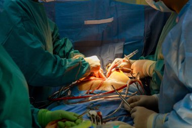 Kalp kapakçığının arızası nedeniyle açık kalp ameliyatı, hastane ameliyathanesinde kapakçık değişimi yapılır.