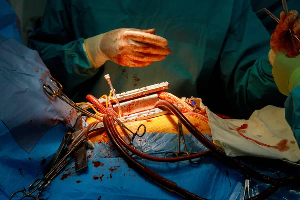 手術室病院で行われている冠動脈疾患による心臓手術の一環として冠動脈バイパス手術が行われています — ストック写真