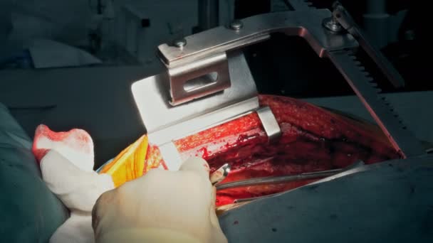 冠動脈バイパス移植 病院手術室における冠動脈心疾患による心臓手術用Cabg — ストック動画