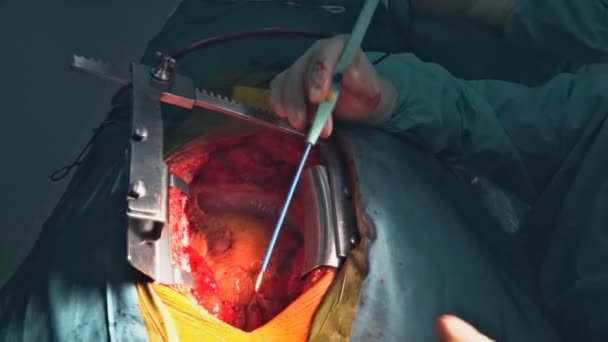 在医院手术室对冠心病引起的心脏手术行冠状动脉旁路移植术 — 图库视频影像