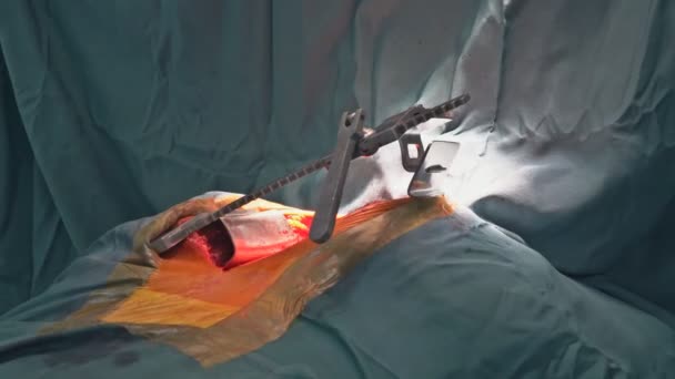 Kalp Kapakçığının Arızası Nedeniyle Açık Kalp Ameliyatı Hastane Ameliyathanesinde Kapakçık — Stok video