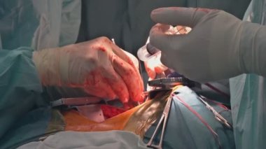 Ameliyathane hastanesinde gerçekleştirilen kalp ameliyatlarının bir parçası olarak koroner arter bypass nakli yapılıyor.