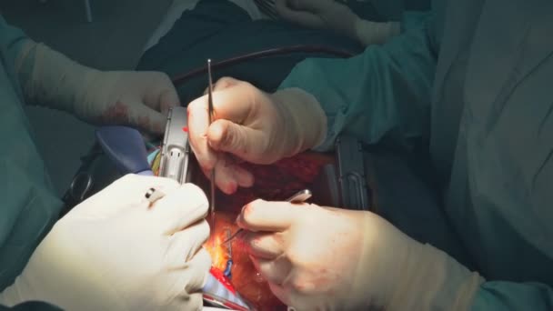 Procedure Coronary Artery Bypass Graft Cabg Operation Heart Due Coronary — Stock Video