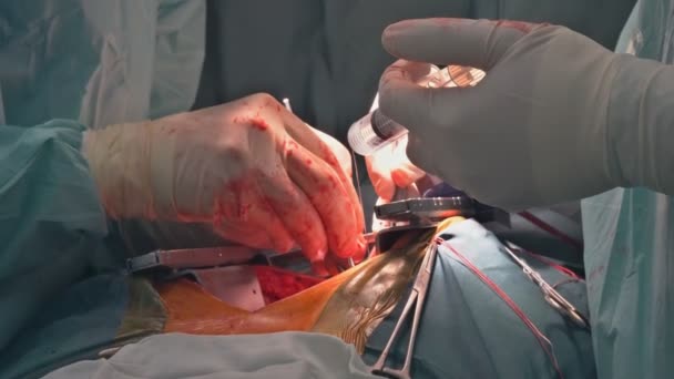 Szívkoszorúér Betegség Miatt Műtőben Végzett Szívműtét Részeként Koszorúér Bypass Átültetéseket — Stock videók