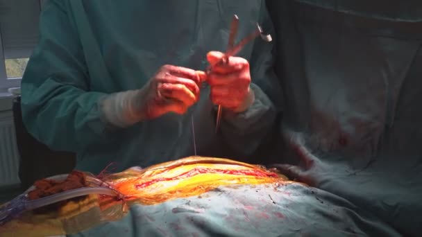 Kranskärlskirurgi Cabg Utförs Sjukhusets Operationssal För Behandling Hjärtsjukdomar Eftersom Kranskärlssjukdom — Stockvideo