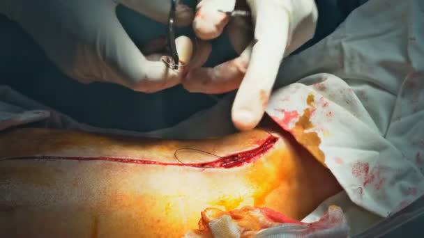 医生在手术室里给受伤的腿缝补伤口是件困难的事情 — 图库视频影像