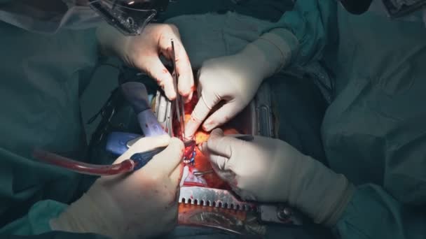 由于心脏瓣膜故障 在手术室进行瓣膜置换术时需要进行开胸手术 — 图库视频影像