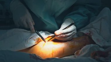 Doktorun geçirdiği büyük bir kazadan sonra bacağı ameliyat odasında dikildi.