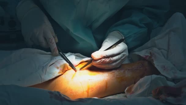 Perna Costurada Ferida Sala Cirurgia Após Acidente Grave Por Médico — Vídeo de Stock