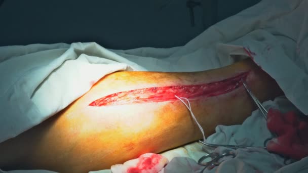 Yaralı Bir Bacak Ameliyat Odasında Bir Doktor Tarafından Dikişle Tedavi — Stok video