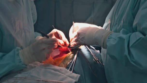 由于心脏瓣膜故障 病人接受开胸心脏手术 包括在手术室进行瓣膜置换术 — 图库视频影像