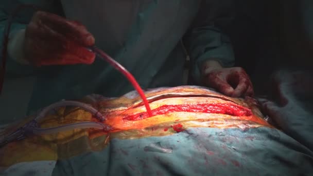 在开胸手术中 如果心脏瓣膜出现故障 可在手术室进行瓣膜置换 以解决这个问题 — 图库视频影像