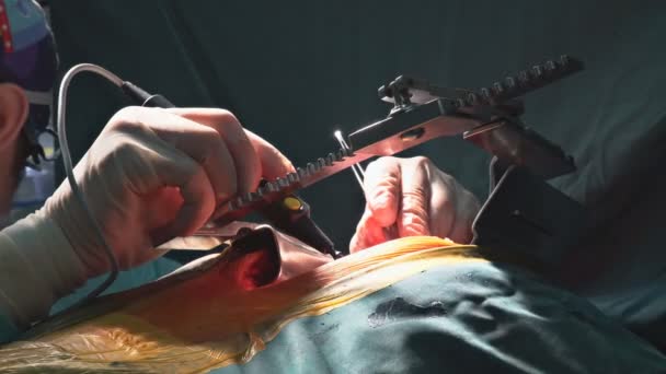 如果心脏瓣膜出现问题 需要进行心脏直视手术 则需要在手术室更换心脏瓣膜 — 图库视频影像