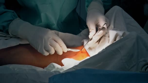 Ameliyat Odasındaki Doktorların Yaralı Bir Bacağı Dikmesi Alışılmadık Bir Şey — Stok video