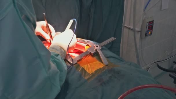 如果心脏瓣膜发生故障 需要更换瓣膜 则在手术室进行开胸手术 — 图库视频影像