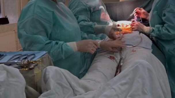 Ett Operationssal Sjukhus Där Kranskärlskirurgi Bypass Grafts Cabg Utförs Som — Stockvideo