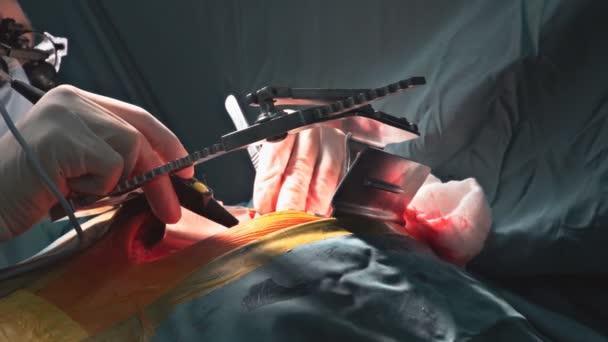 由于心脏瓣膜故障 病人接受开胸心脏手术 包括在手术室进行瓣膜置换术 — 图库视频影像